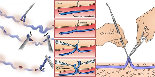 Варикоз Вен На Ногах Удаление