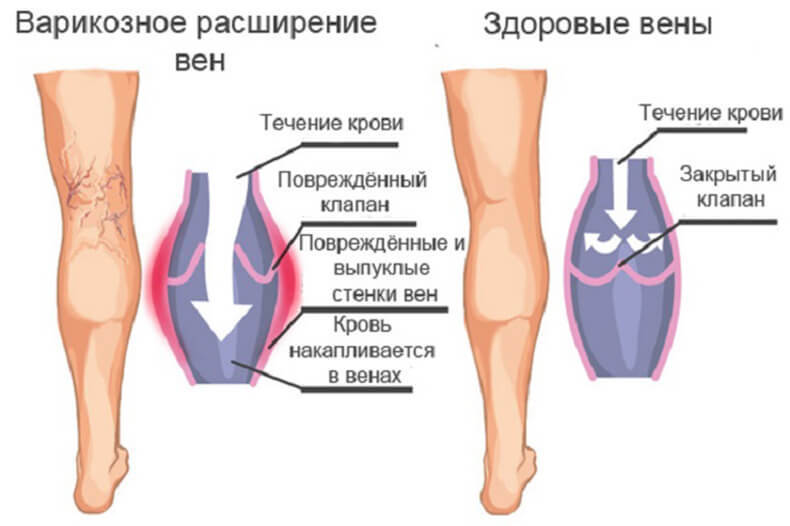 Лечение варикозного расширения вен