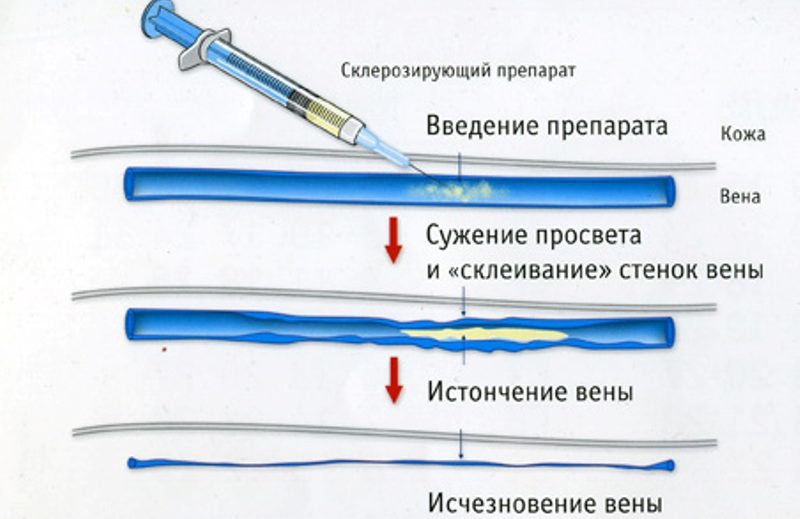 склеротерапия во время беременности