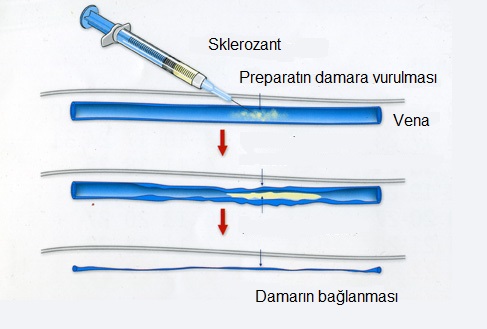 skleroterapiya