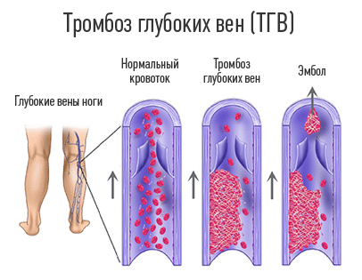 тромбоз вен